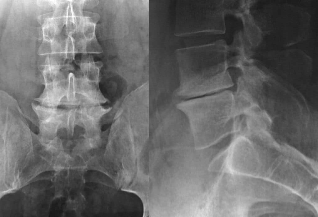 radiographie - Chirurgie rachidienne